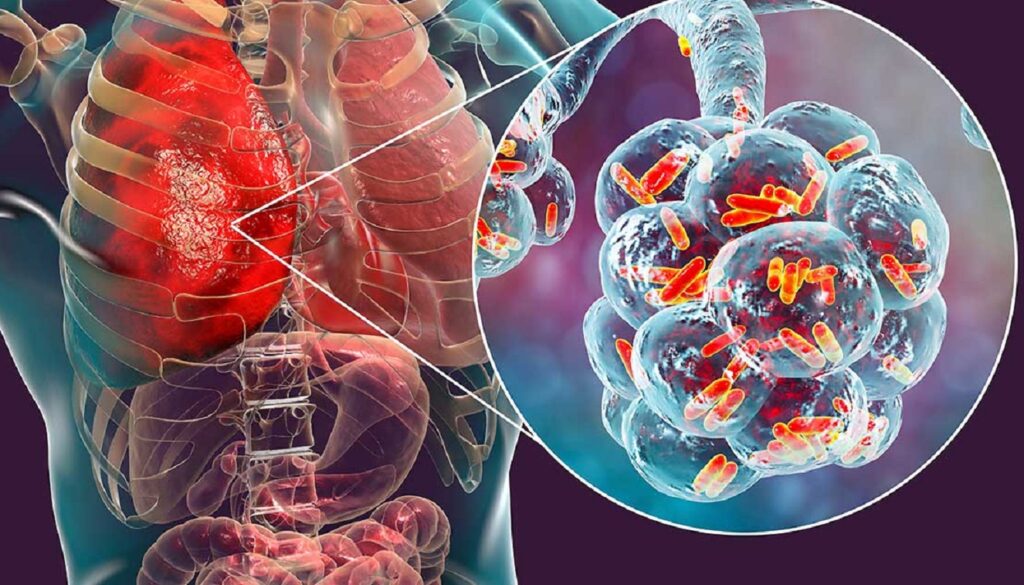 Legionella